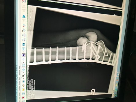 Radiograph of the The Player&#39;s right front fetlock, repaired with a locking metal plate and 16 screws.