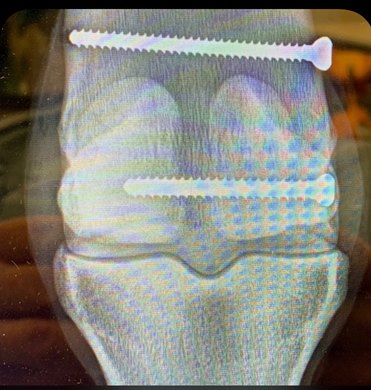 Nadal X-ray with screws